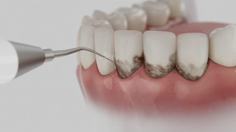 Trusted Wisdom Tooth Removal service in Cleary, MS - Dentist Open Now